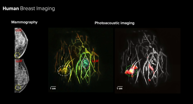 The Incredible Cancer-Detecting Potential of Photoacoustic Imaging
